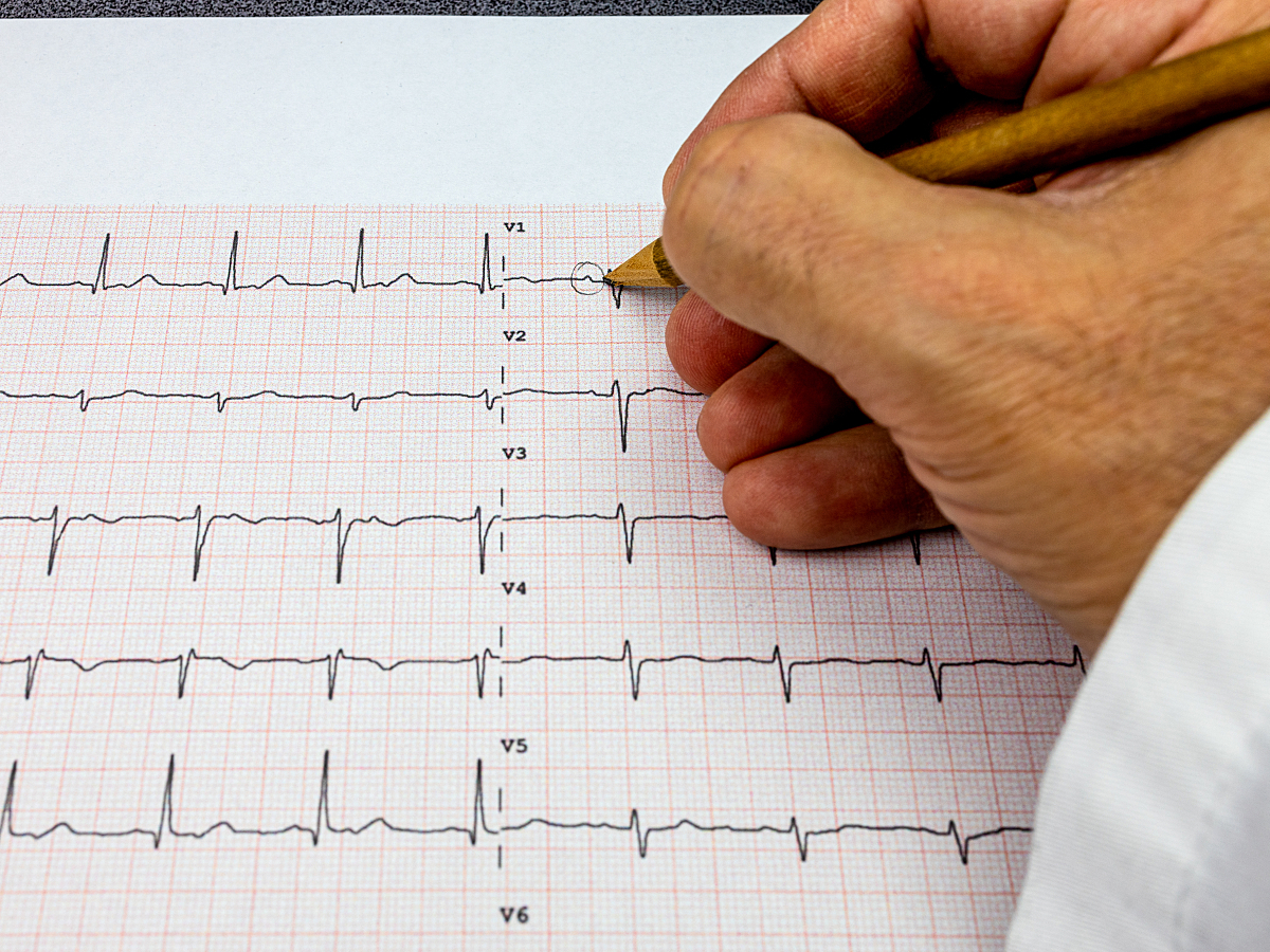 تفسیر نوار ECG